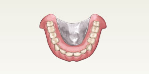 フルデンチャー（総入れ歯）