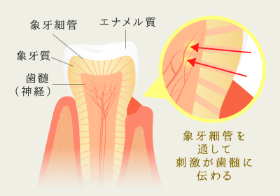 象牙細管を通して刺激が歯髄に伝わる