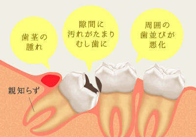 歯茎の腫れ、隙間に汚れがたまりむし歯に、周囲の歯並びが悪化