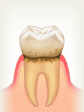 軽度歯周病